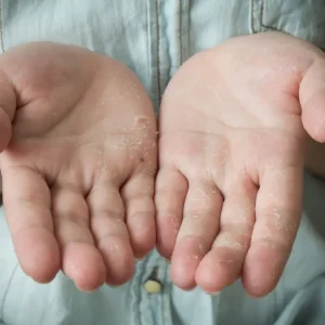 پوسته شدن کف دست